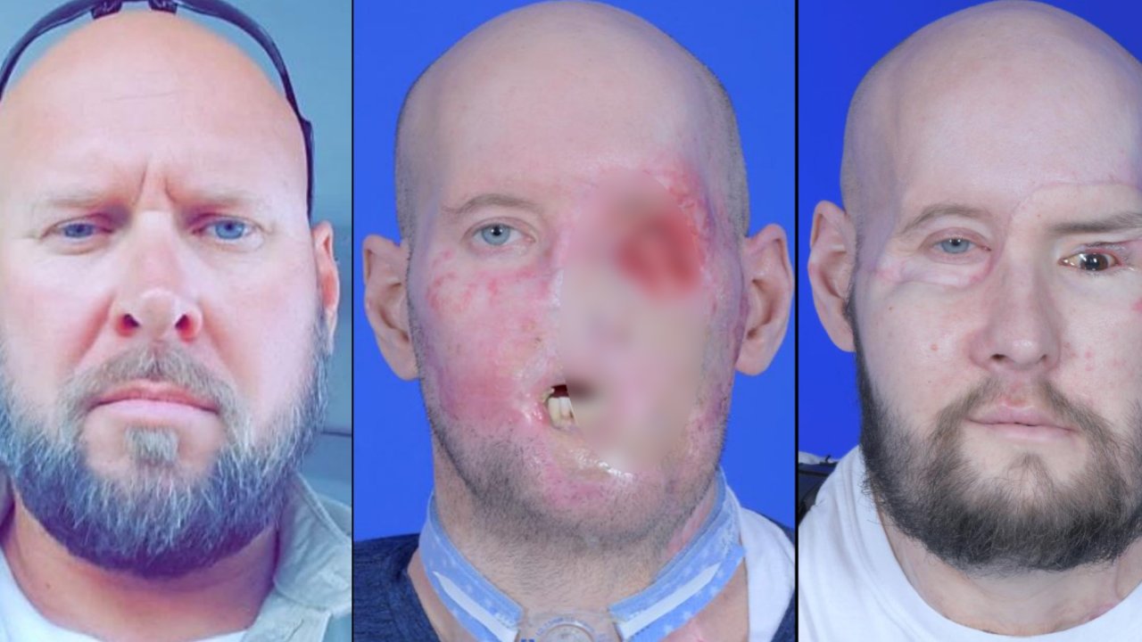 ABD’de bir hastaya ‘tam göz’ nakli yapıldı