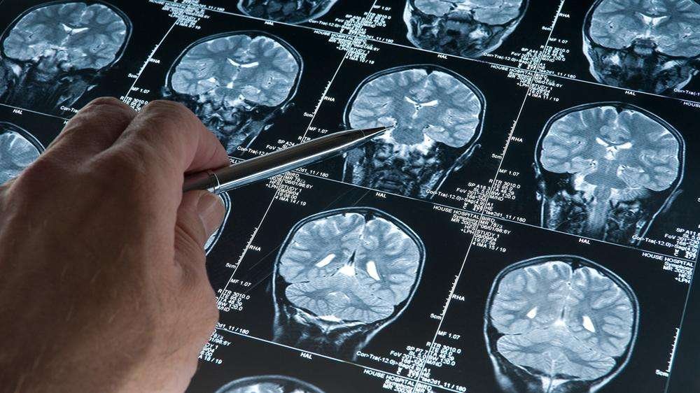 Alzheimer araştırmalarında riski artıran genetik varyant bulundu