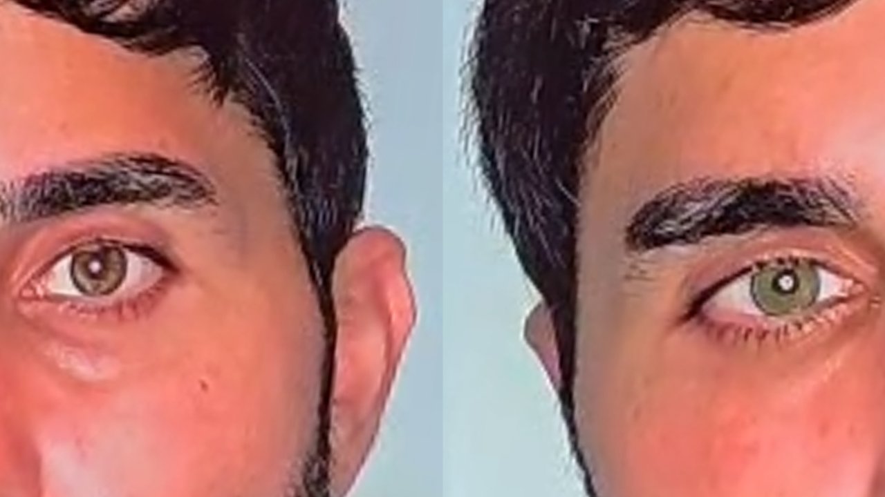 Göz rengini kalıcı olarak değiştirmek mümkün; en çok mavi ve yeşil uygulanıyor