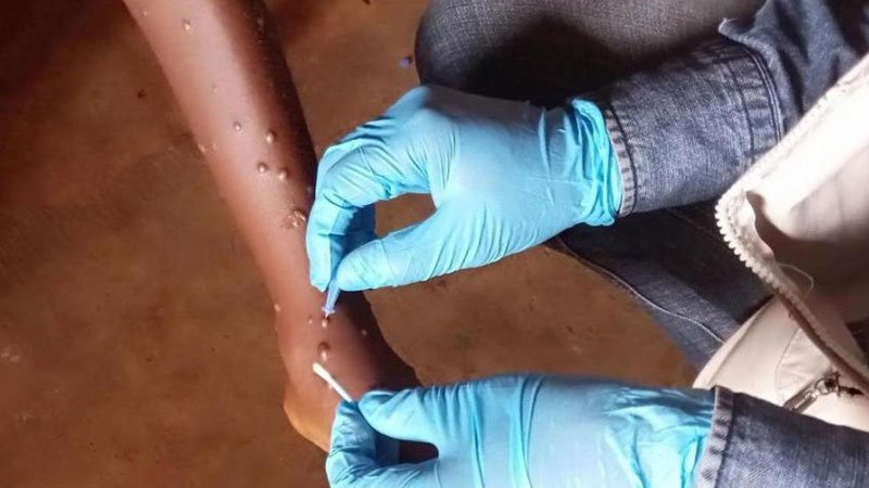 Gana'da M-çiçeği vaka sayısı 302'ye yükseldi