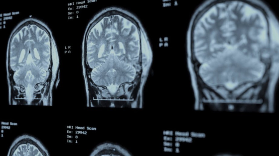 New study finds possible link between green tea and Alzheimer’s protection