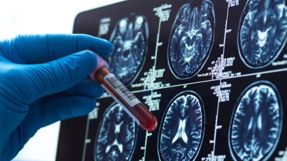 Böyük Britaniyada Altsheymer xəstəliyinin erkən aşkarlanması üçün yeni qan testi hazırlanıb
