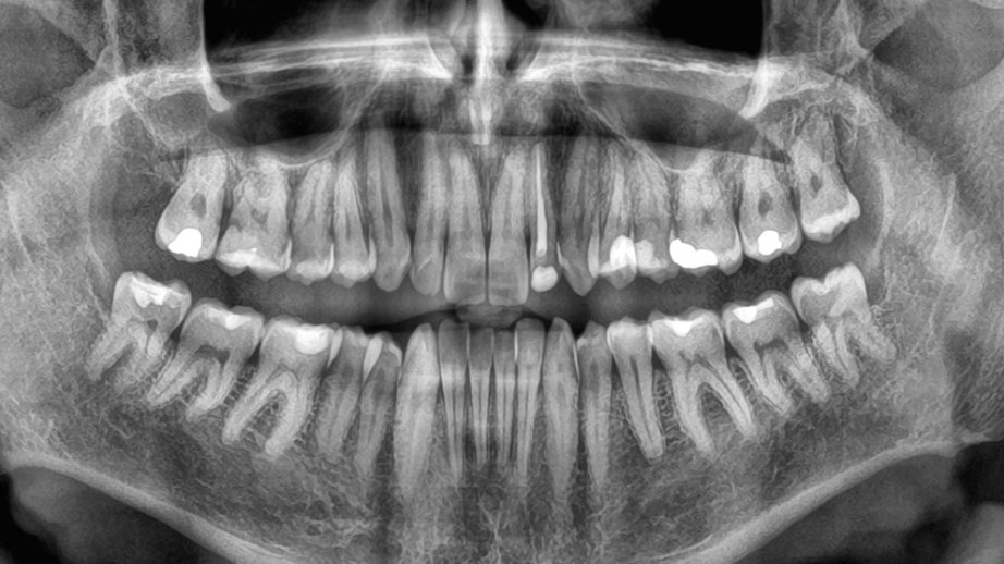Araşdırma: Diş itkisi ölüm riskini artıra bilər