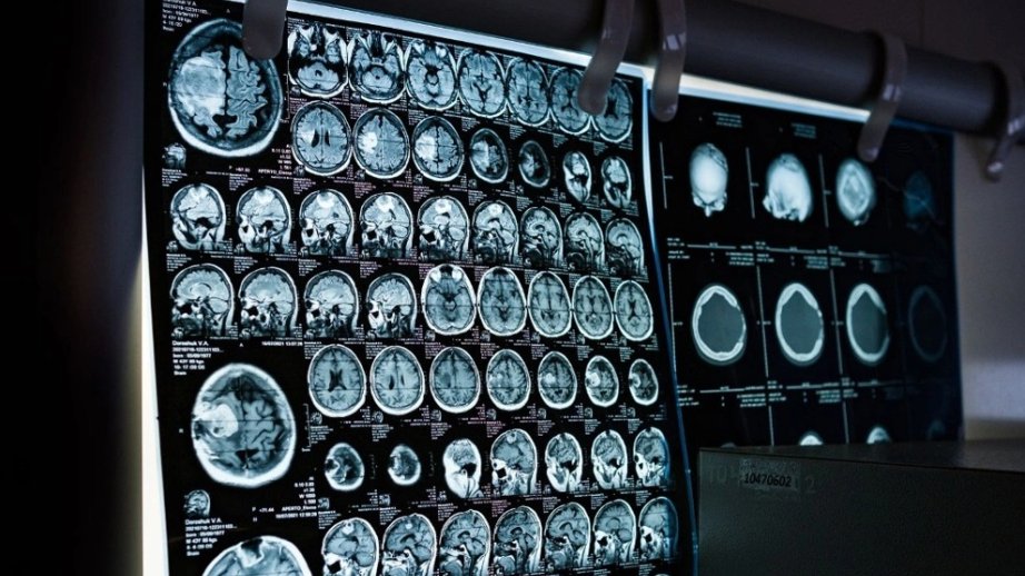 Scientists discover how Alzheimer's may destroy brain cells