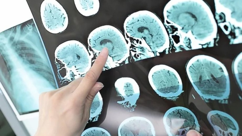 Researchers develop artery-on-a-chip to help predict stroke risk