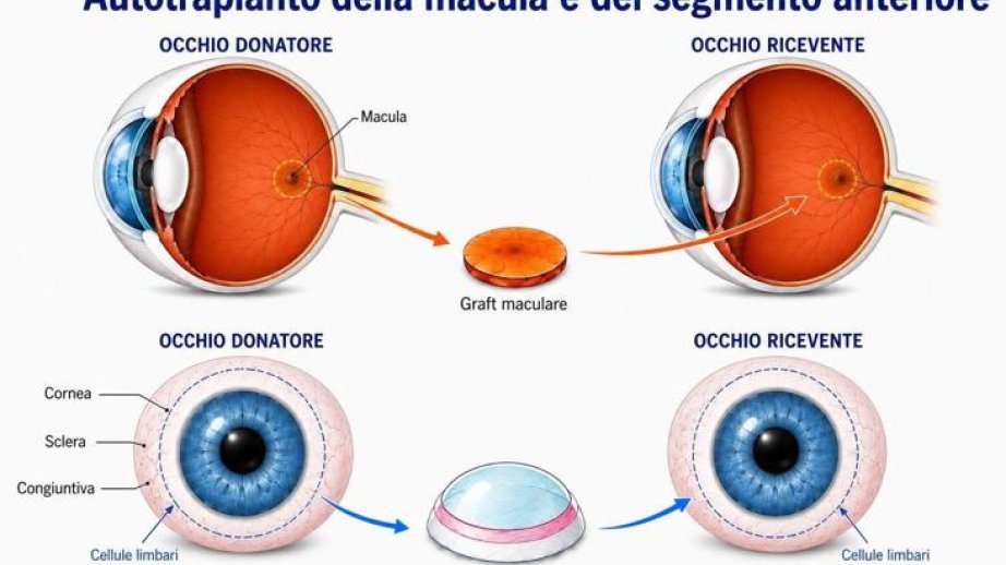 Dünyada ilk dəfə bir gözdən digərinə torlu qişa köçürülməsi əməliyyatı uğurla həyata keçirilib