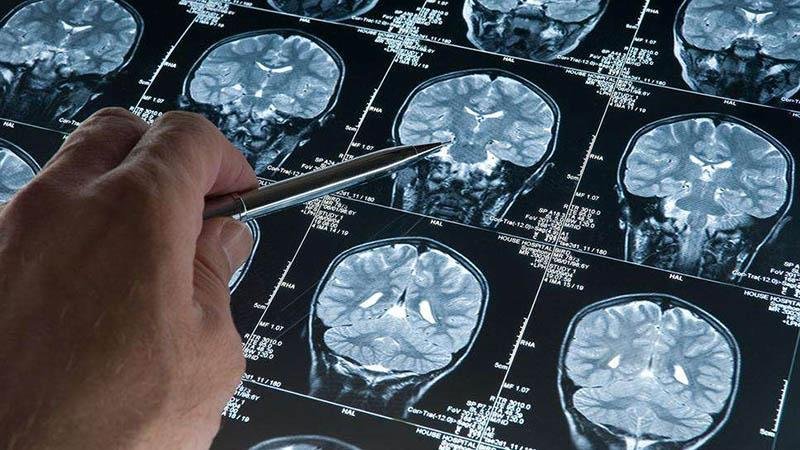 Research: Deep Sleep Slows Down Alzheimer's