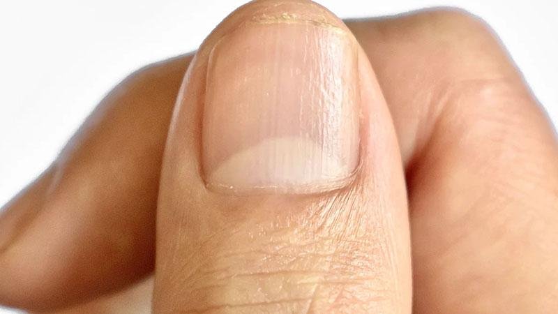 Araşdırma: Dırnaq diblərindəki qızartı gizli xəstəliklərin xəbərçisi ola bilər