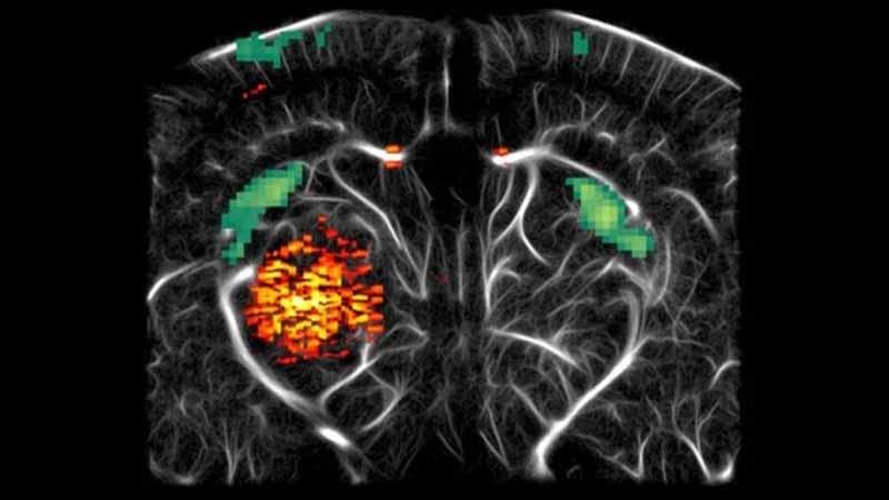 Research: New ultrasound technique reveals deadly brain cancer's invasion plan